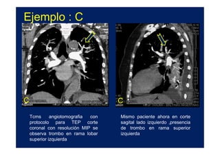 Ejemplo : C




C                                   C

    Tcms      angiotomografia con   Mismo paciente ahora en corte
    protocolo para TEP corte        sagital lado izquierdo ,presencia
    coronal con resolución MIP se   de trombo en rama superior
    observa trombo en rama lobar    izquierda
    superior izquierda
 