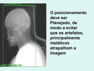 O posicionamento deve ser  Planejado, de modo a evitar que os artefatos, principalmente metálicos  atrapalhem a imagem 