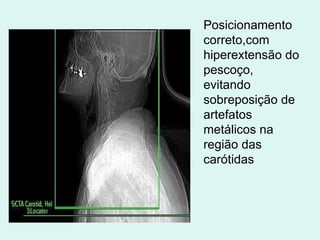 Posicionamento correto,com hiperextensão do  pescoço, evitando sobreposição de artefatos metálicos na região das carótidas 