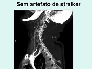 Sem artefato de straiker 