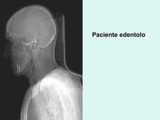 Paciente edentolo 