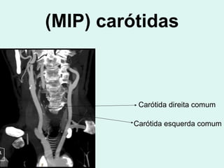 (MIP) carótidas Carótida direita comum Carótida esquerda comum 
