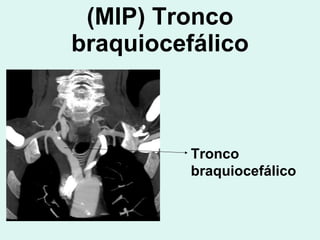 (MIP) Tronco braquiocefálico Tronco braquiocefálico 