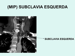 (MIP) SUBCLAVIA ESQUERDA SUBCLAVIA ESQUERDA 