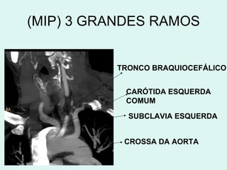 (MIP) 3 GRANDES RAMOS CROSSA DA AORTA SUBCLAVIA ESQUERDA CARÓTIDA ESQUERDA COMUM TRONCO BRAQUIOCEFÁLICO 