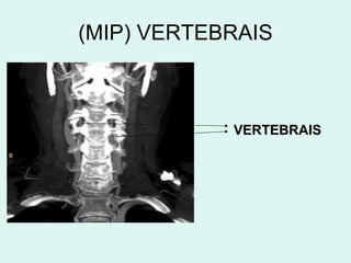 (MIP) VERTEBRAIS VERTEBRAIS 