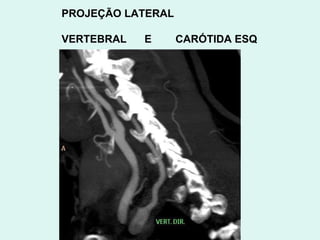 PROJEÇÃO LATERAL VERTEBRAL  E  CARÓTIDA ESQ 