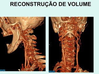 RECONSTRUÇÃO DE VOLUME 