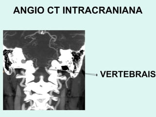 ANGIO CT INTRACRANIANA VERTEBRAIS 