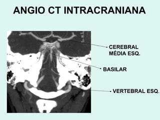 CEREBRAL MÉDIA ESQ. BASILAR VERTEBRAL ESQ . ANGIO CT INTRACRANIANA 