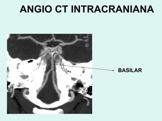 ANGIO CT INTRACRANIANA BASILAR 