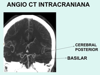 ANGIO CT INTRACRANIANA BASILAR CEREBRAL POSTERIOR 