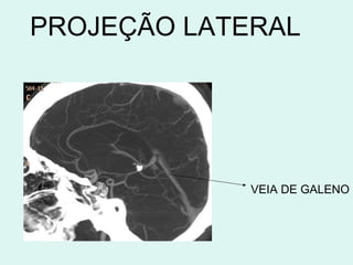 PROJEÇÃO LATERAL VEIA DE GALENO 