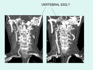 VERTEBRAL ESQ.? 