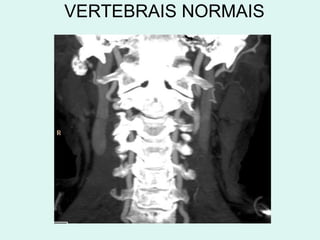 VERTEBRAIS NORMAIS 