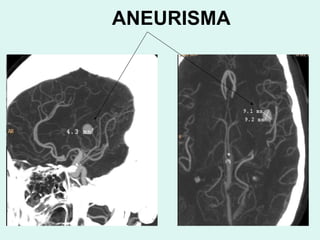ANEURISMA 