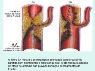 A figura 6A mostra o estreitamento acentuado da bifurcação da carótida com prometendo o fluxo sangüíneo. A 6B mostra ulceração de placa de ateroma que provoca liberação de fragmentos do trombo. 