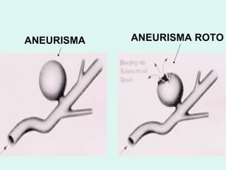 ANEURISMA ANEURISMA ROTO 