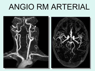 ANGIO RM ARTERIAL 