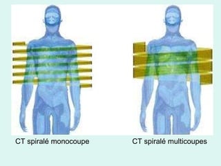 CT spiralé monocoupe    CT spiralé multicoupes  