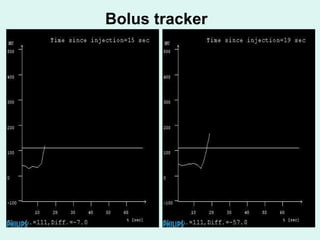 Bolus tracker 