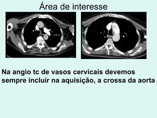 Área de interesse Na angio tc de vasos cervicais devemos sempre incluir na aquisição, a crossa da aorta 