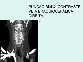 PUNÇÃO  MSD , CONTRASTE VEIA BRAQUIOCEFÁLICA DIREITA. 