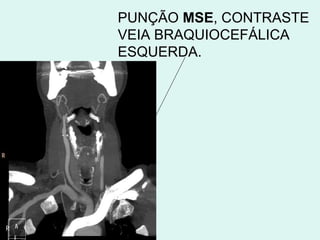 PUNÇÃO  MSE , CONTRASTE VEIA BRAQUIOCEFÁLICA ESQUERDA. 