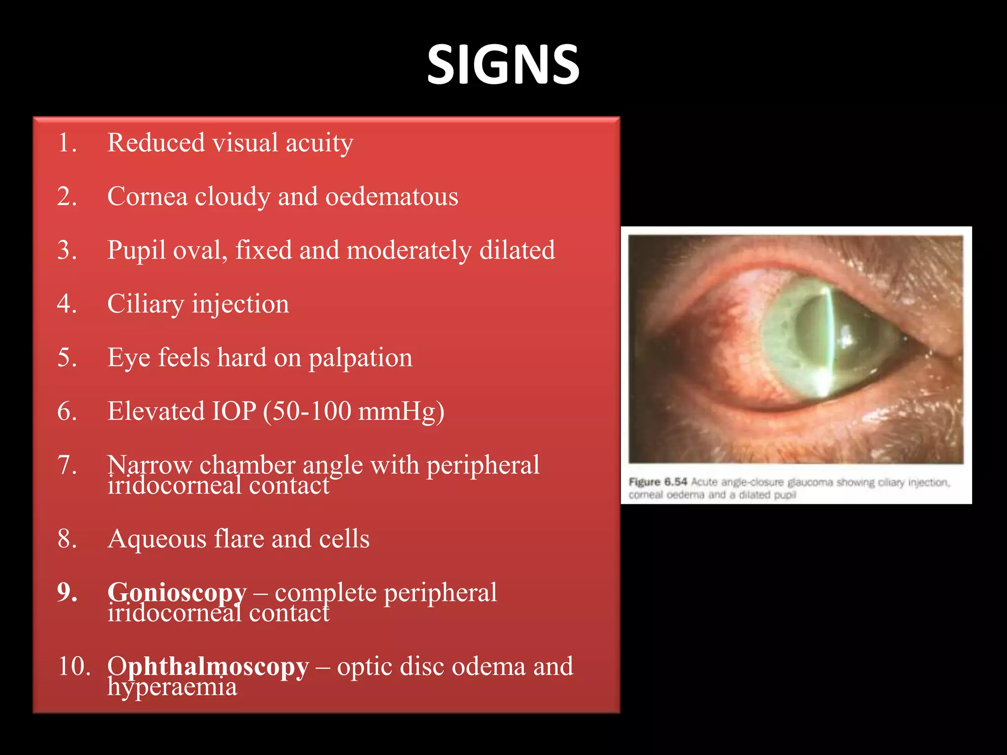 SIGNSReduced visual acuityCornea cloudy and oedematousPupil oval, fixed and moderately dilatedCiliaryinjectionEye feels hard on palpationElevated IOP (50-100 mmHg)Narrow chamber angle with peripheral iridocornealcontactAqueous flare and cellsGonioscopy– complete peripheral iridocornealcontactOphthalmoscopy– optic disc odema and hyperaemia