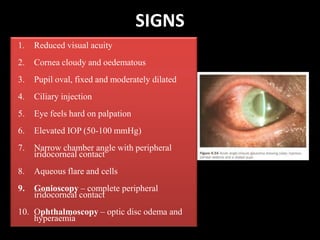 SIGNSReduced visual acuityCornea cloudy and oedematousPupil oval, fixed and moderately dilatedCiliaryinjectionEye feels hard on palpationElevated IOP (50-100 mmHg)Narrow chamber angle with peripheral iridocornealcontactAqueous flare and cellsGonioscopy– complete peripheral iridocornealcontactOphthalmoscopy– optic disc odema and hyperaemia
