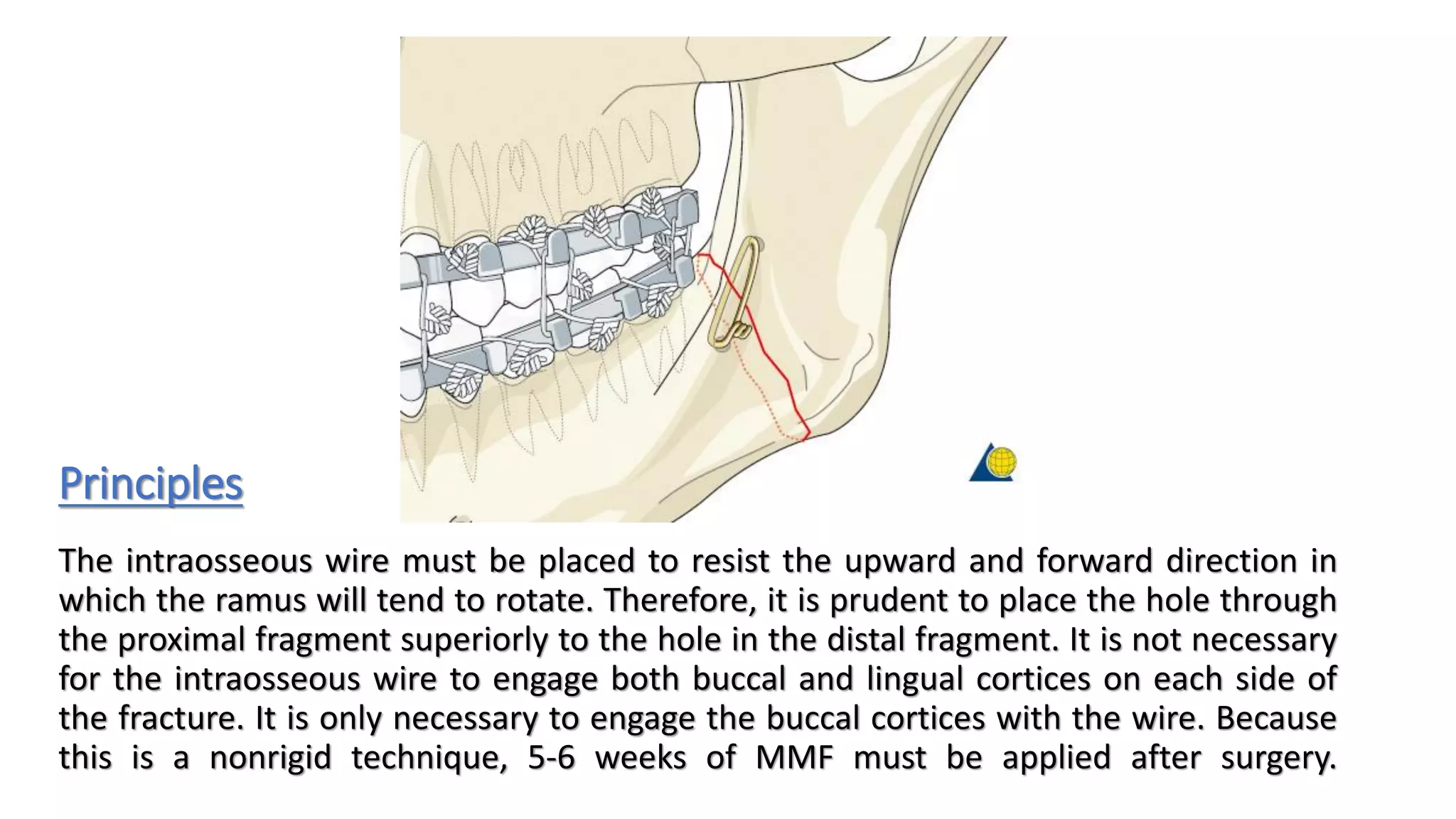 Angle and ramus fracture, simple | PDF