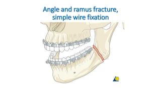 Angle and ramus fracture,
simple wire fixation
 