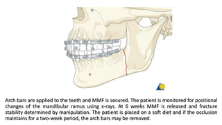 Angle and ramus fracture, simple | PDF