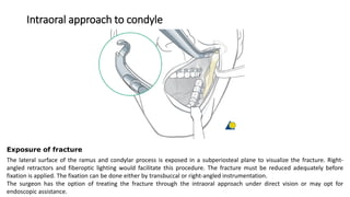 Angle and ramus fracture, simple | PDF