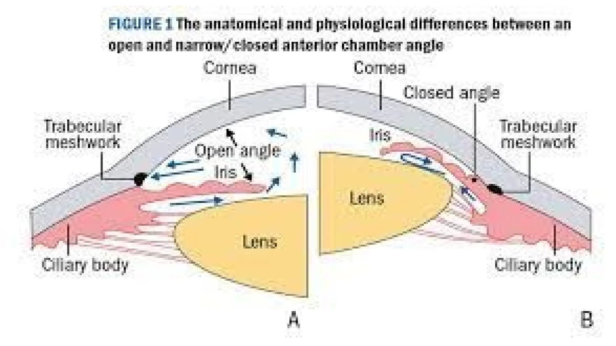 Angle Closure ophthalmology for medical students | PPT