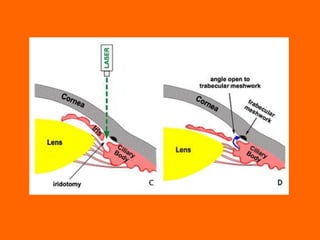 Angle closure glaucoma | PPTX