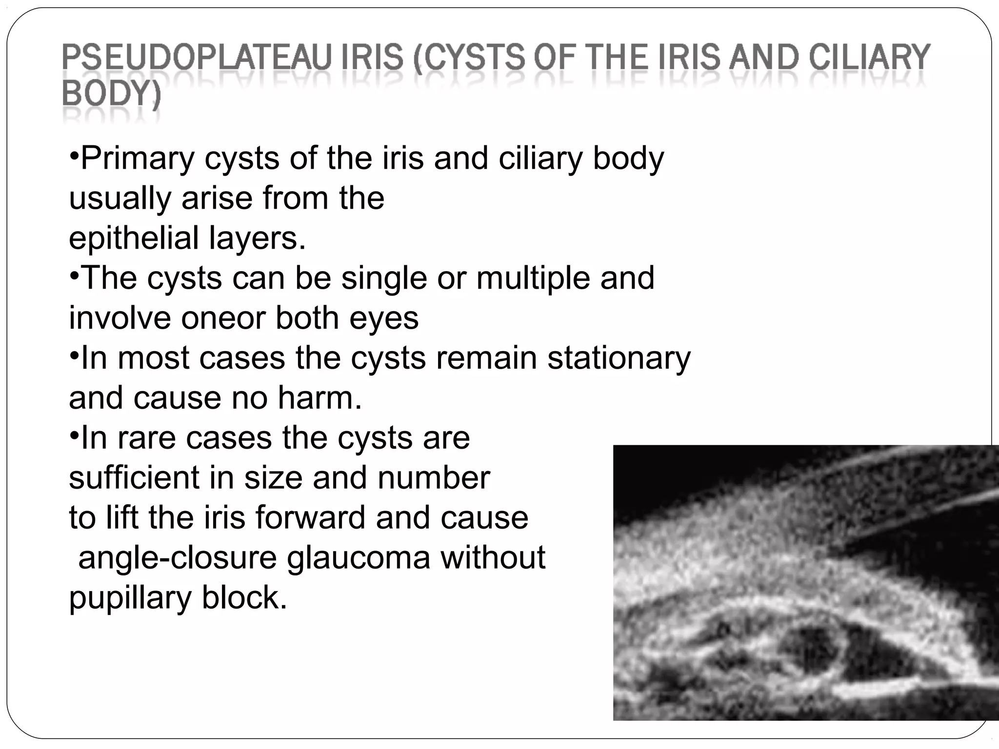 •Primary cysts of the iris and ciliary body
usually arise from the
epithelial layers.
•The cysts can be single or multiple and
involve oneor both eyes
•In most cases the cysts remain stationary
and cause no harm.
•In rare cases the cysts are
sufficient in size and number
to lift the iris forward and cause
angle-closure glaucoma without
pupillary block.
 