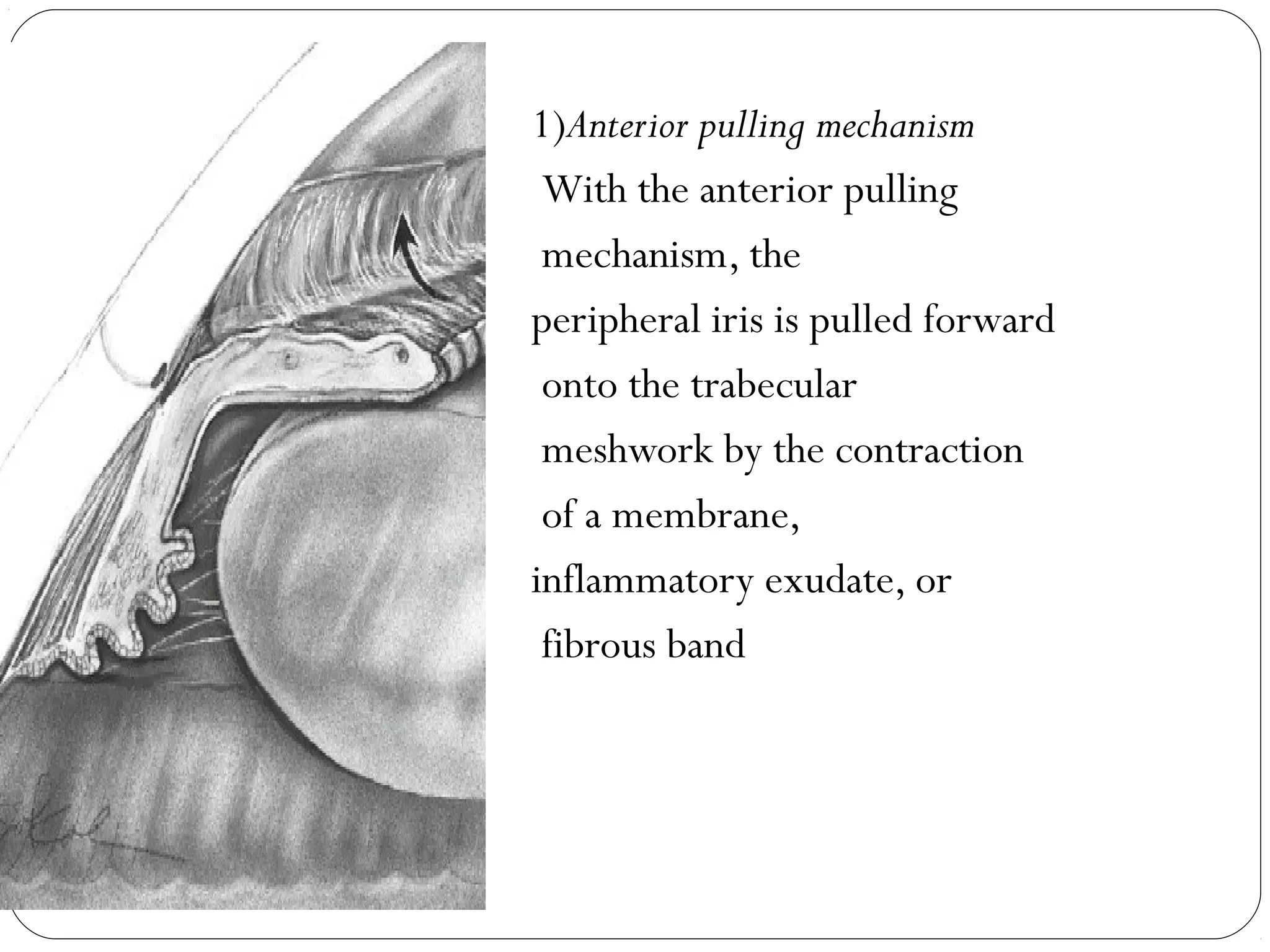 1)Anterior pulling mechanism
With the anterior pulling
mechanism, the
peripheral iris is pulled forward
onto the trabecular
meshwork by the contraction
of a membrane,
inflammatory exudate, or
fibrous band
 
