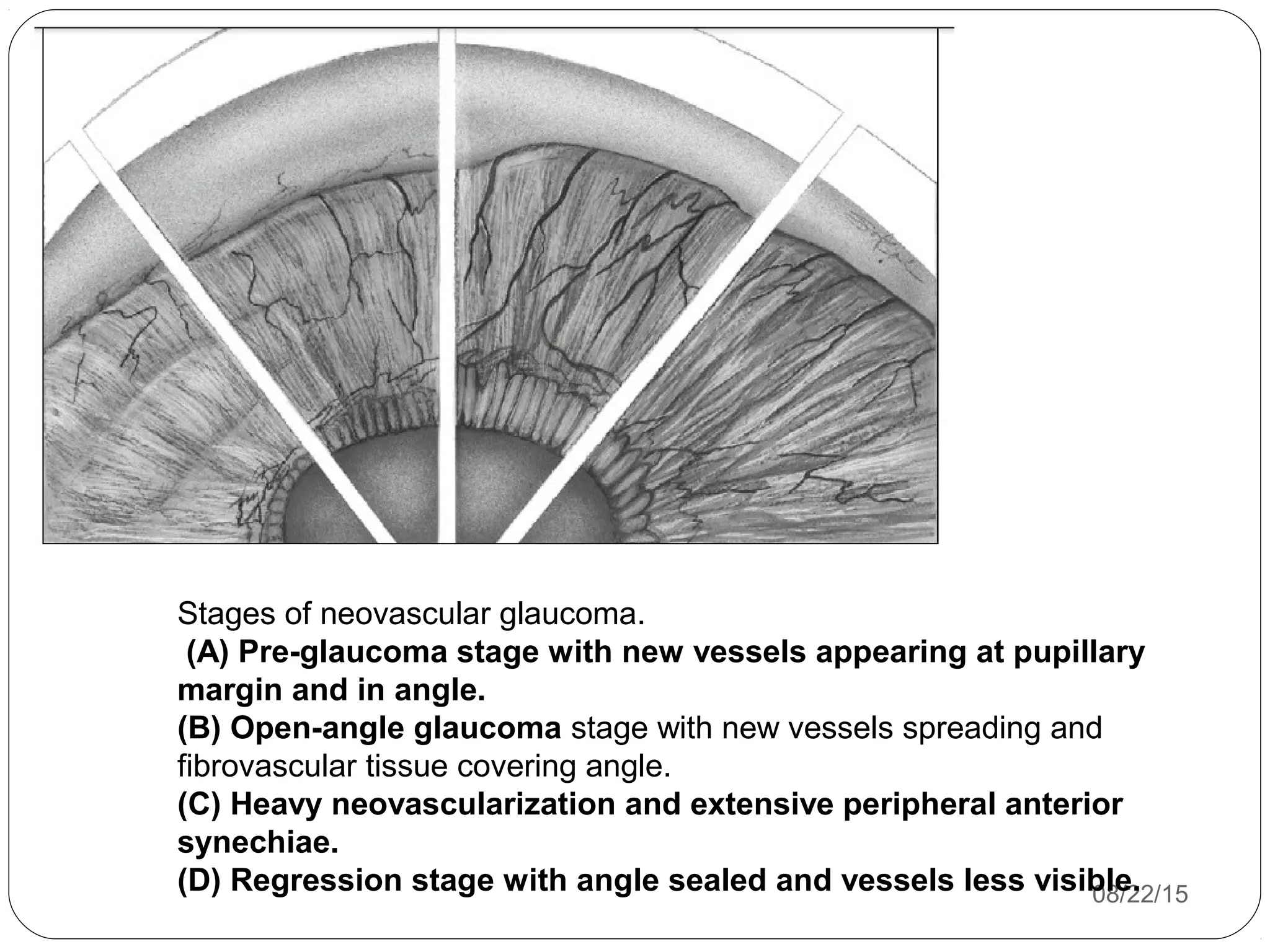 08/22/15
Stages of neovascular glaucoma.
(A) Pre-glaucoma stage with new vessels appearing at pupillary
margin and in angle.
(B) Open-angle glaucoma stage with new vessels spreading and
fibrovascular tissue covering angle.
(C) Heavy neovascularization and extensive peripheral anterior
synechiae.
(D) Regression stage with angle sealed and vessels less visible.
 