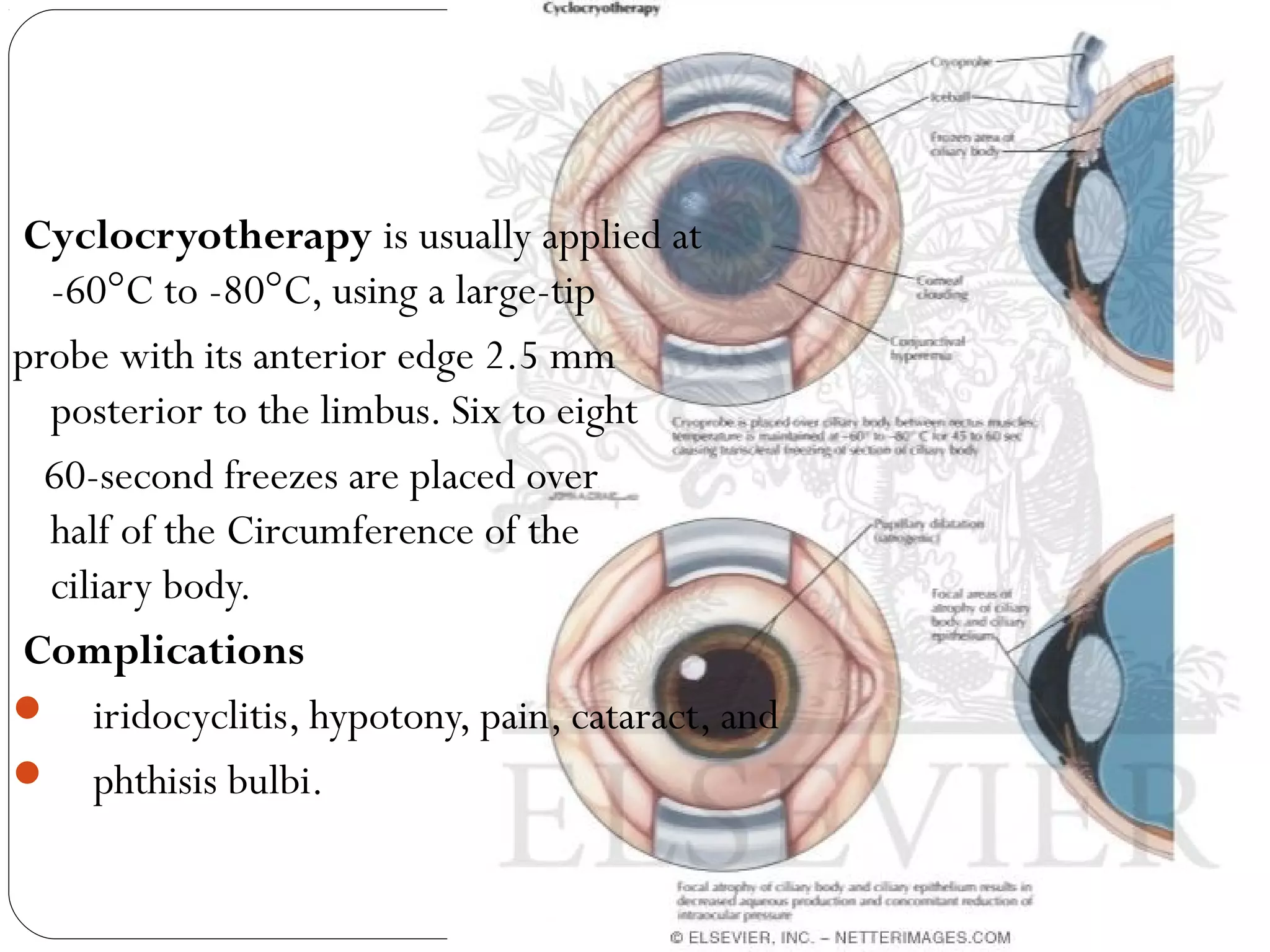 Cyclocryotherapy is usually applied at
-60°C to -80°C, using a large-tip
probe with its anterior edge 2.5 mm
posterior to the limbus. Six to eight
60-second freezes are placed over
half of the Circumference of the
ciliary body.
Complications
 iridocyclitis, hypotony, pain, cataract, and
 phthisis bulbi.
 
