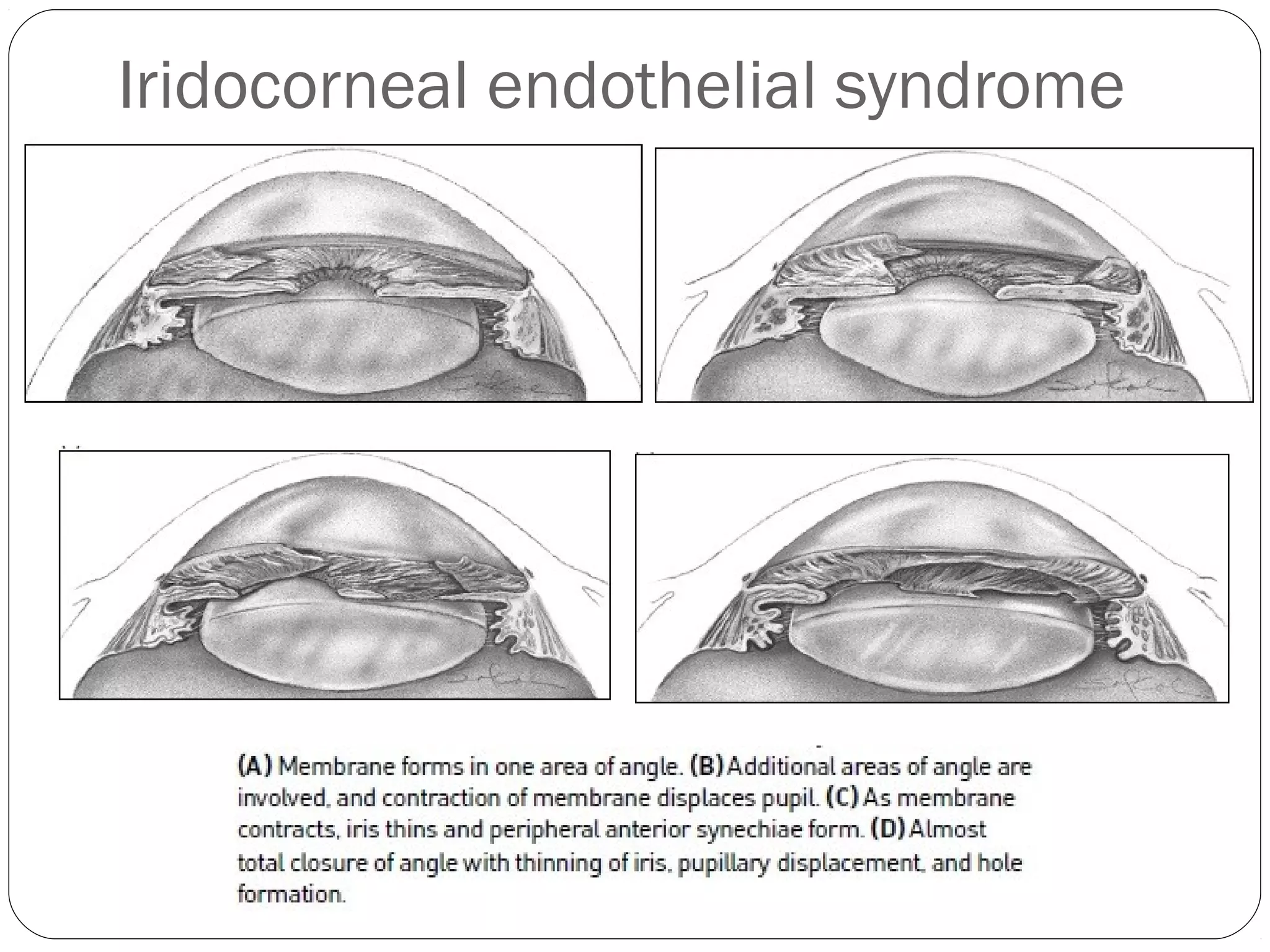 Iridocorneal endothelial syndrome
 