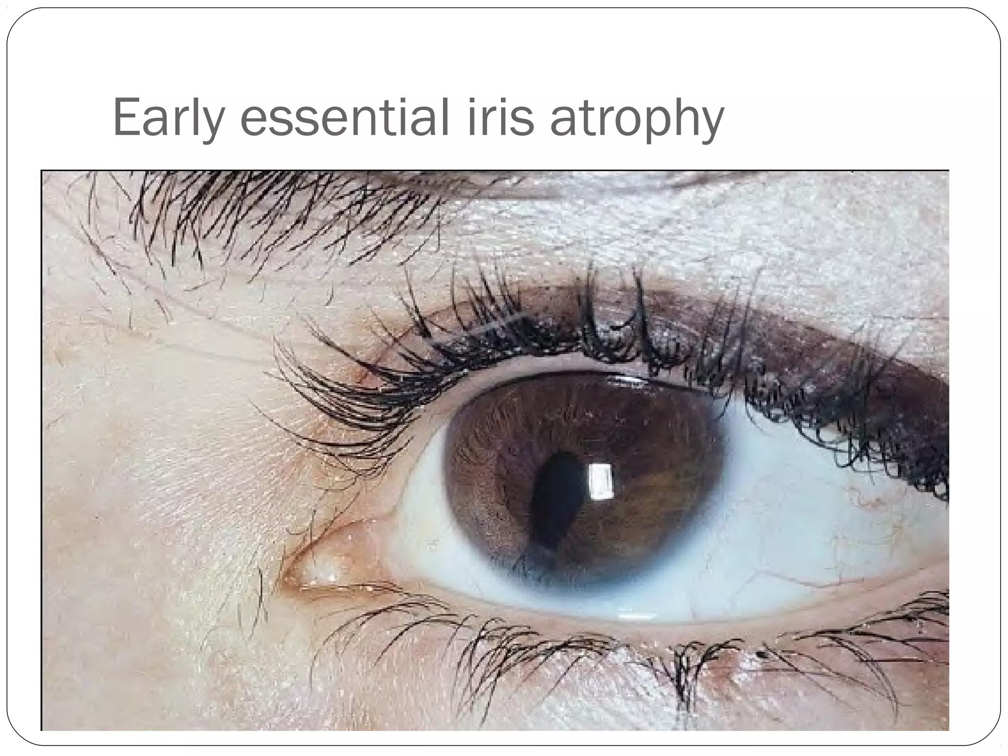Early essential iris atrophy
 