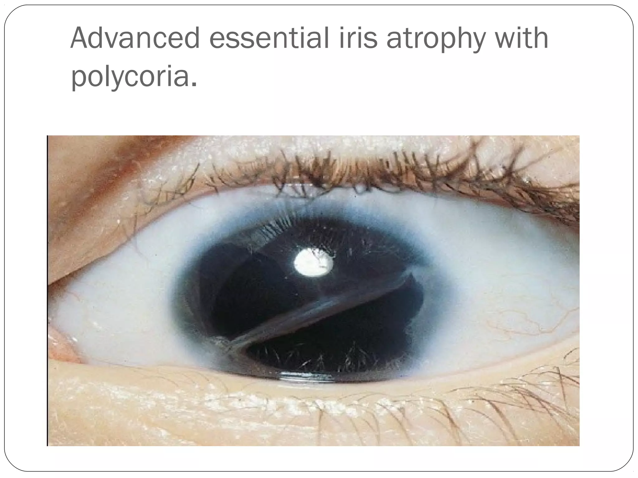 Advanced essential iris atrophy with
polycoria.
 