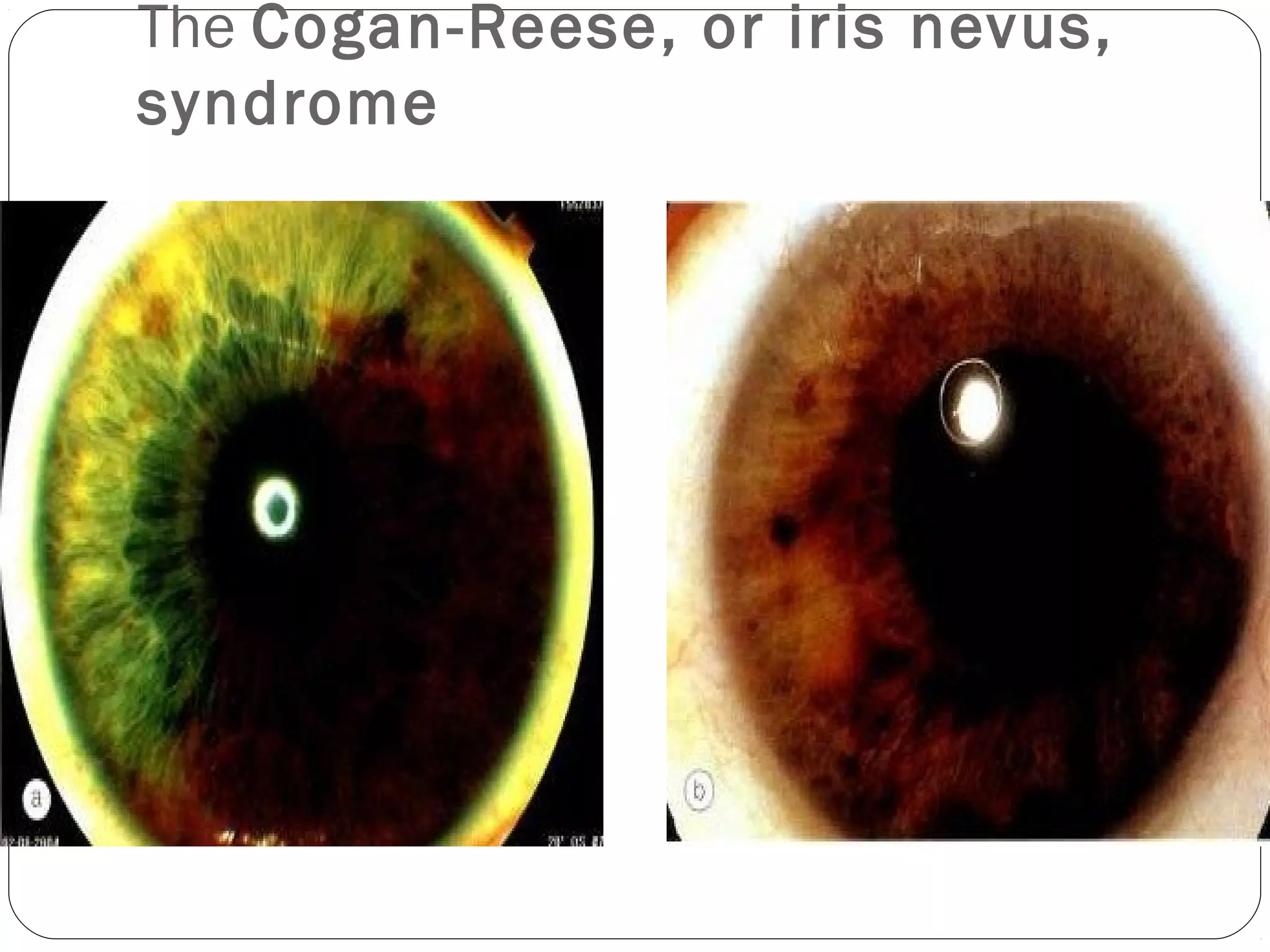 The Cogan-Reese, or iris nevus,
syndrome
 