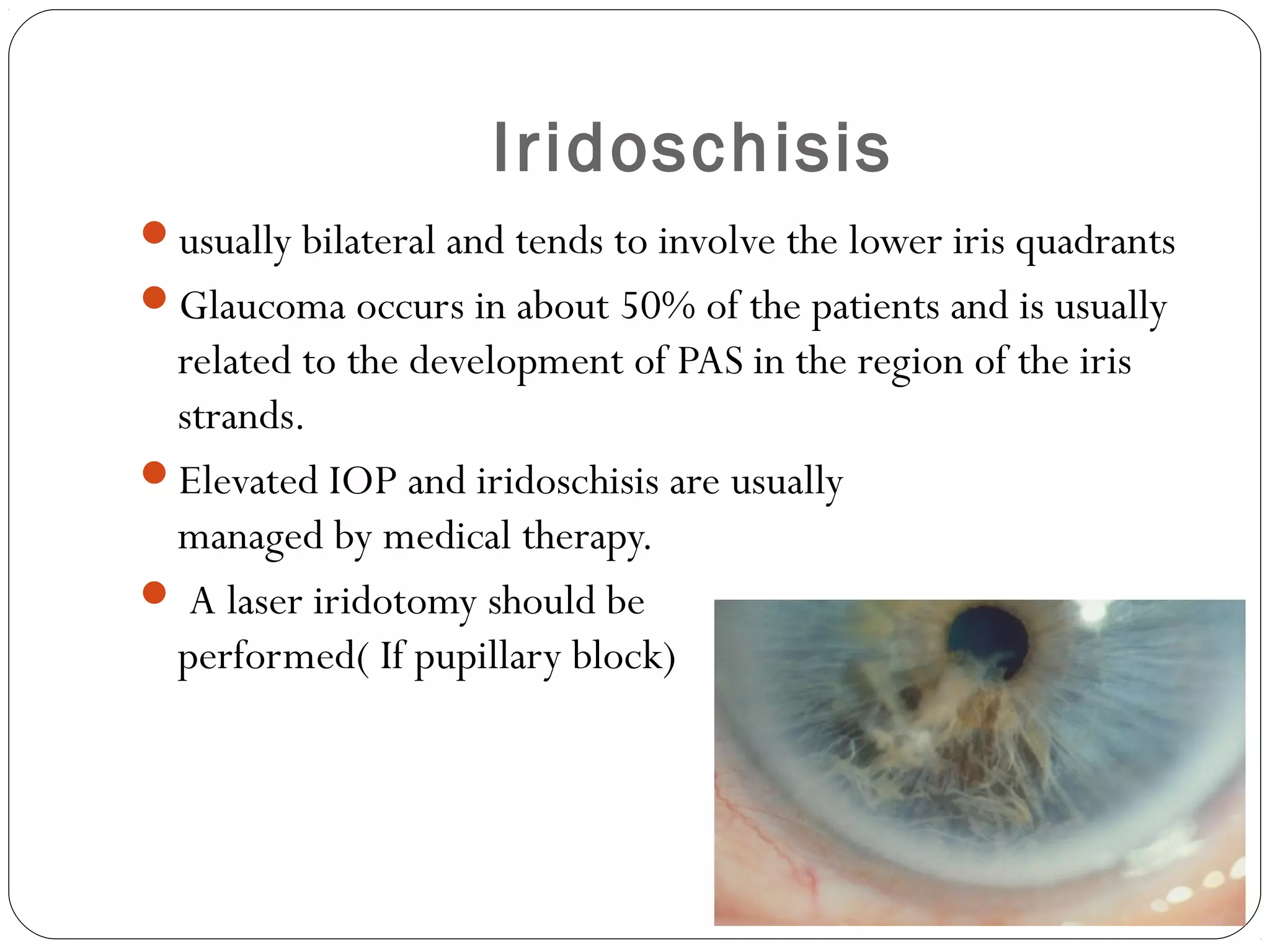 Iridoschisis
usually bilateral and tends to involve the lower iris quadrants
Glaucoma occurs in about 50% of the patients and is usually
related to the development of PAS in the region of the iris
strands.
Elevated IOP and iridoschisis are usually
managed by medical therapy.
 A laser iridotomy should be
performed( If pupillary block)
 