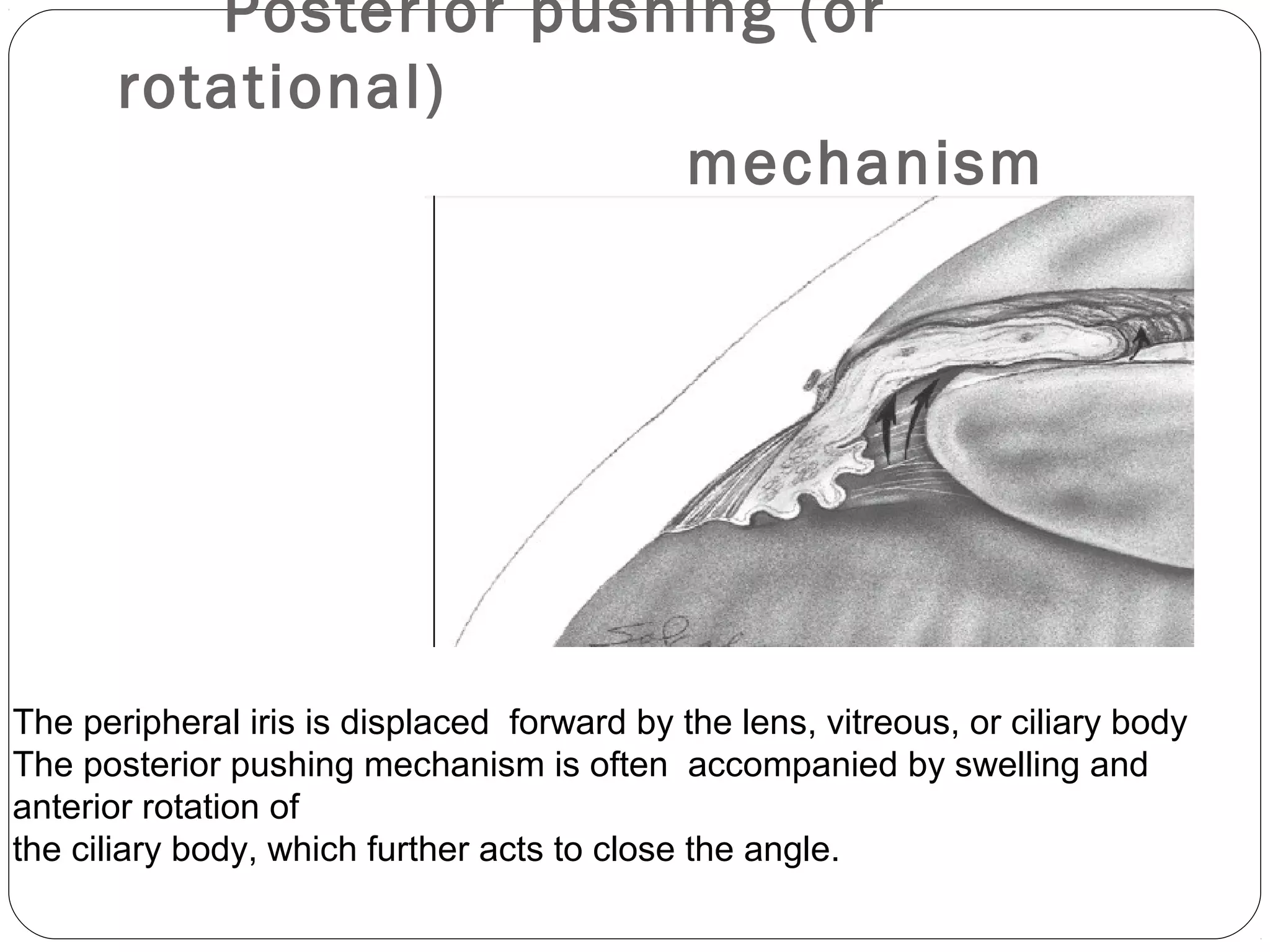 Posterior pushing (or
rotational)
mechanism
The peripheral iris is displaced forward by the lens, vitreous, or ciliary body
The posterior pushing mechanism is often accompanied by swelling and
anterior rotation of
the ciliary body, which further acts to close the angle.
 