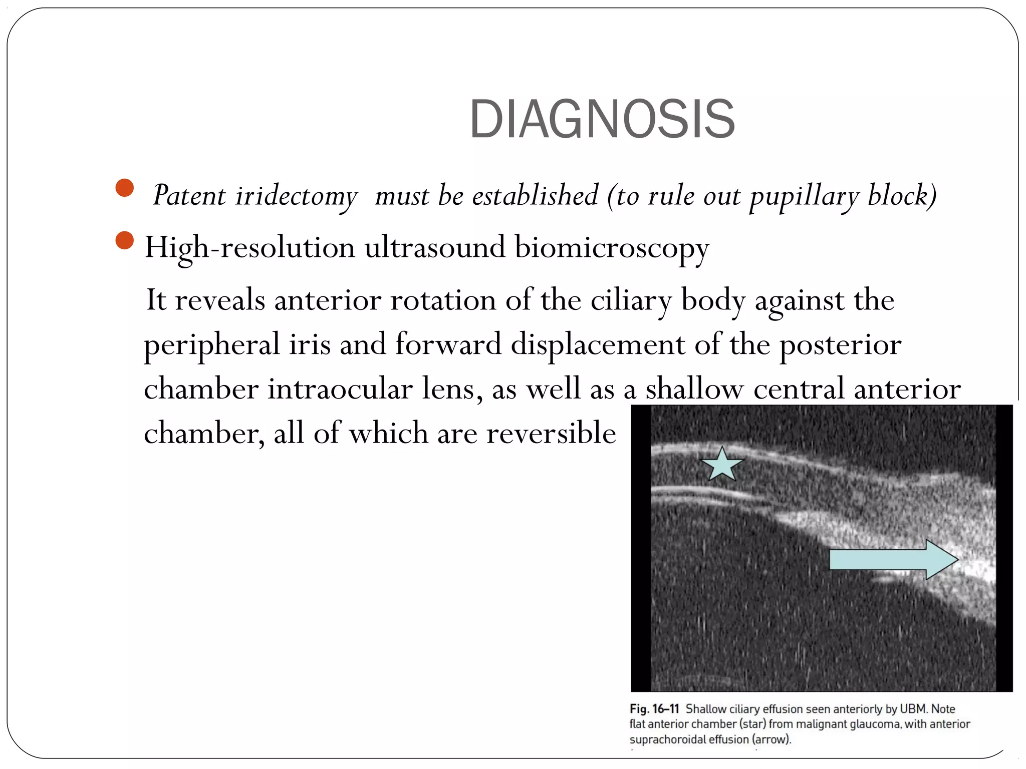 DIAGNOSIS
 Patent iridectomy must be established (to rule out pupillary block)
High-resolution ultrasound biomicroscopy
It reveals anterior rotation of the ciliary body against the
peripheral iris and forward displacement of the posterior
chamber intraocular lens, as well as a shallow central anterior
chamber, all of which are reversible
 