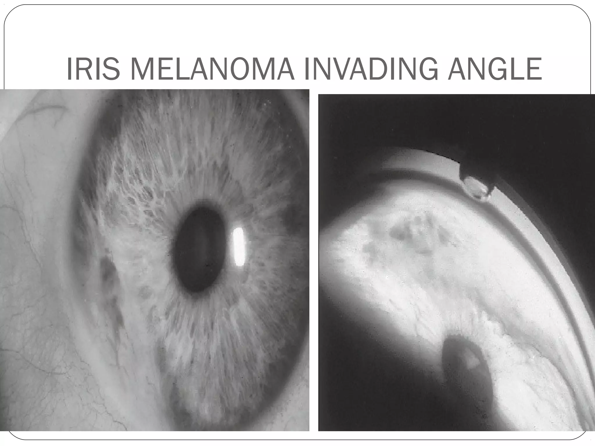 IRIS MELANOMA INVADING ANGLE
 