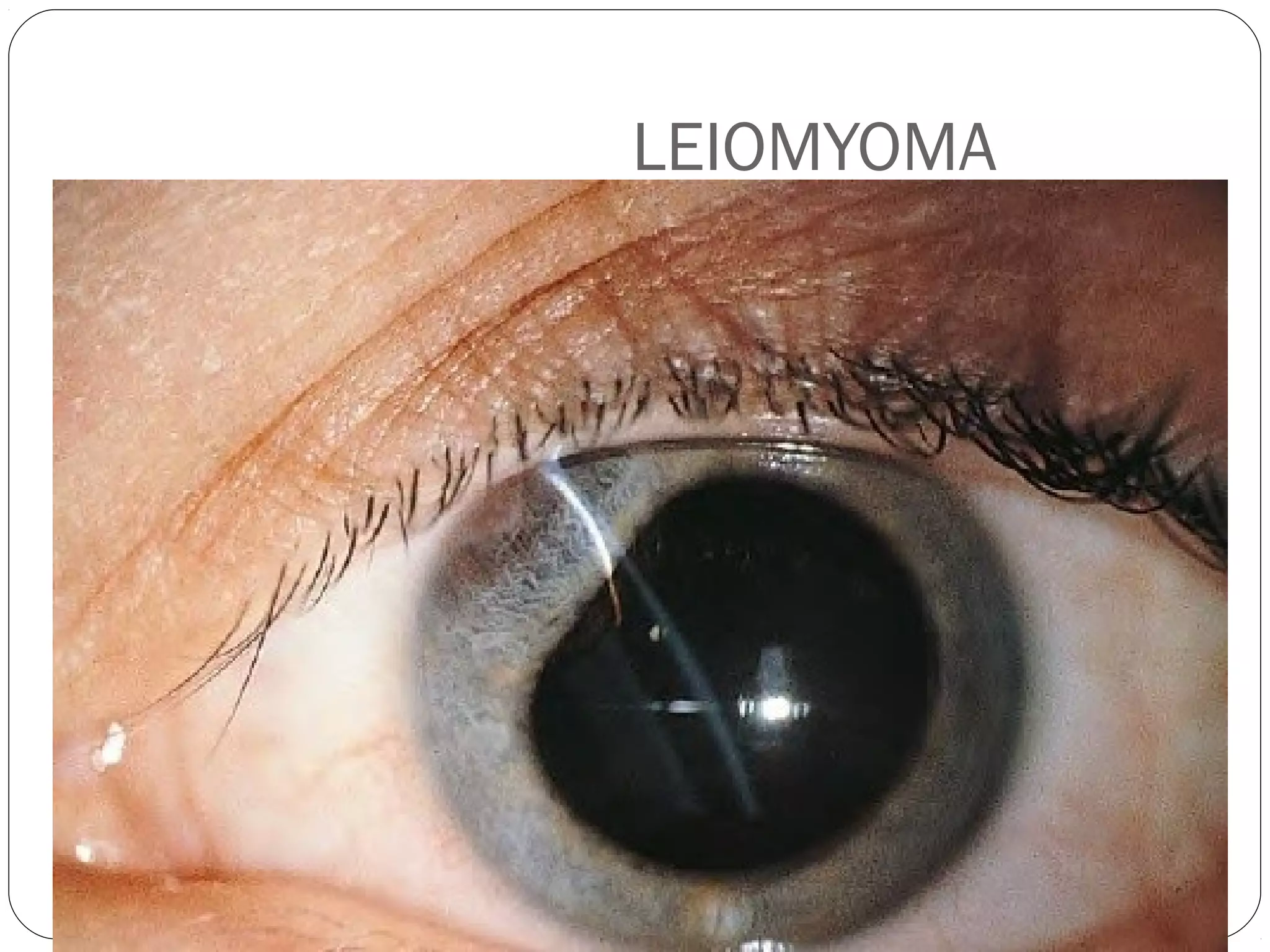 LEIOMYOMA
 