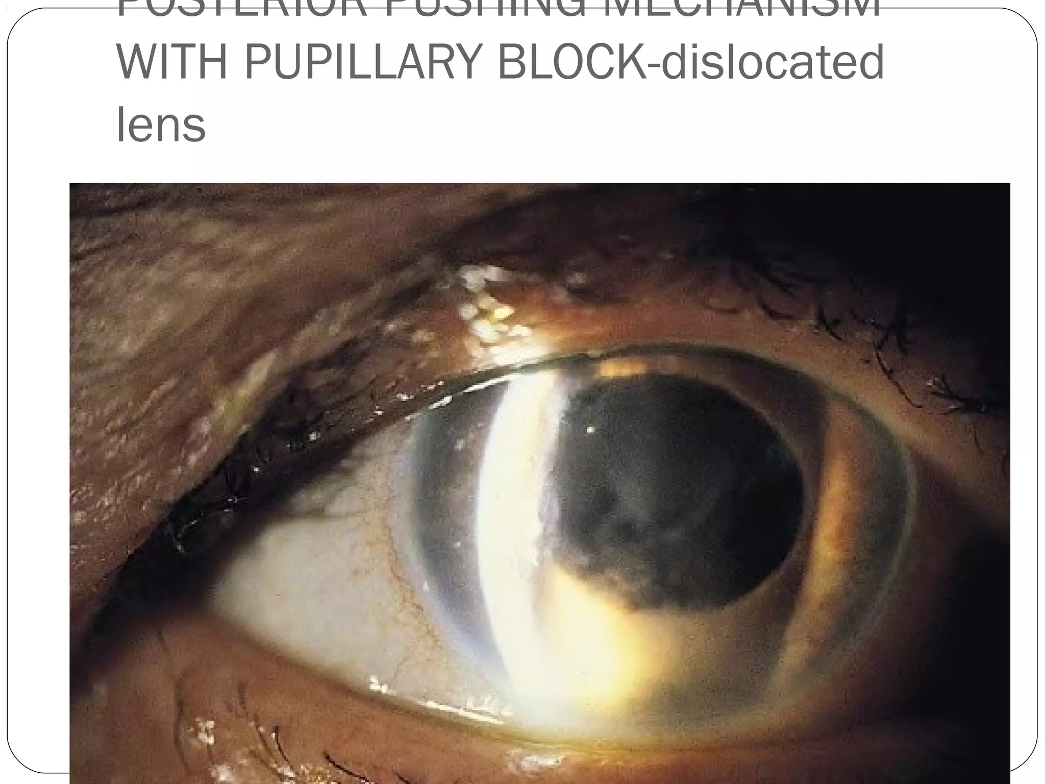 POSTERIOR PUSHING MECHANISM
WITH PUPILLARY BLOCK-dislocated
lens
 